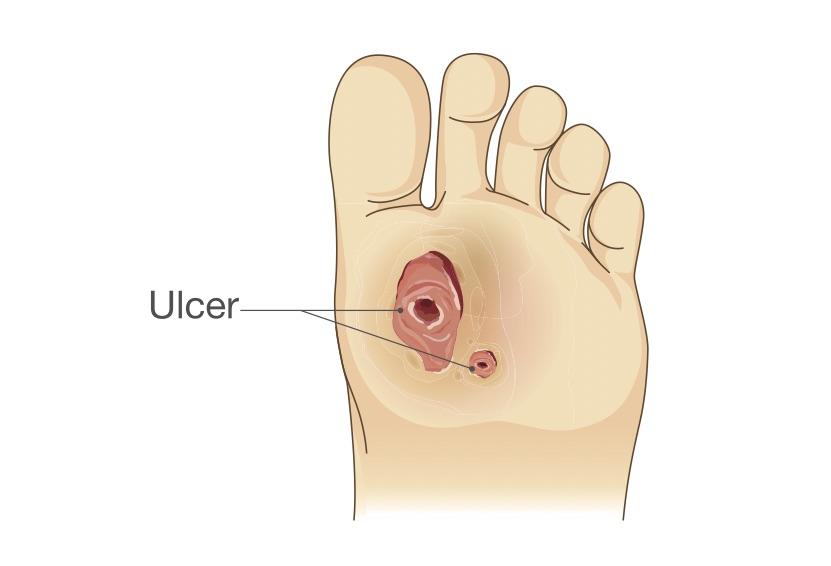 How to treat foot ulcers and pain