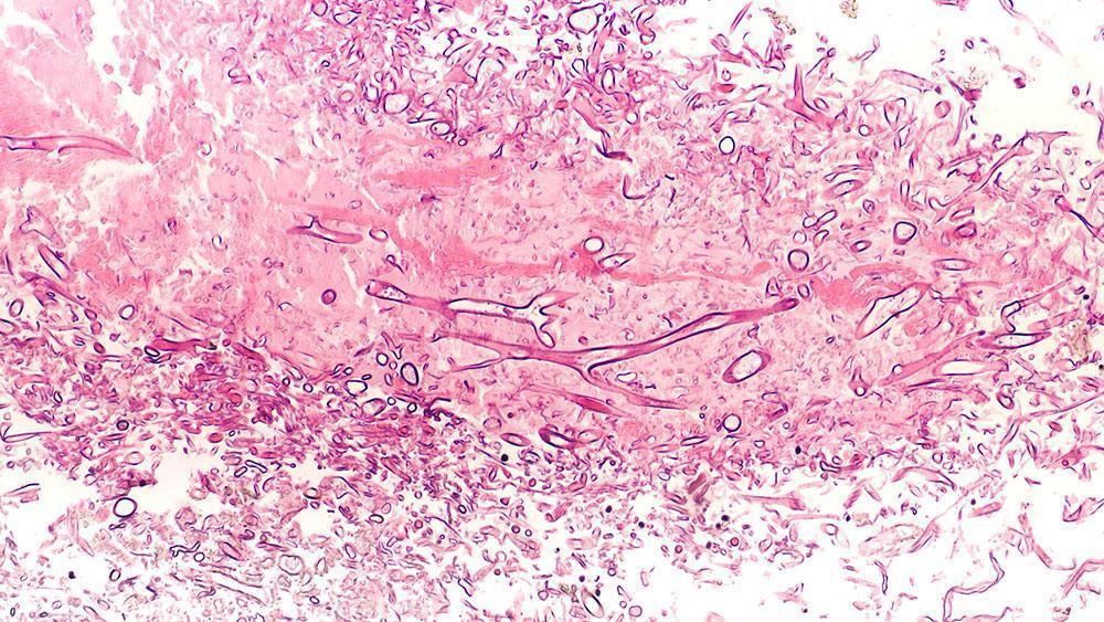 mucormycosis in india
