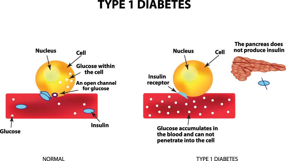 symptoms of type 1 diabetes