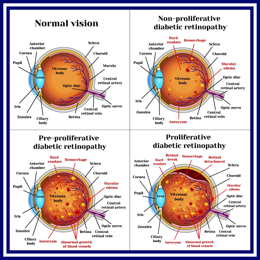 causes of diabetic retinopathy