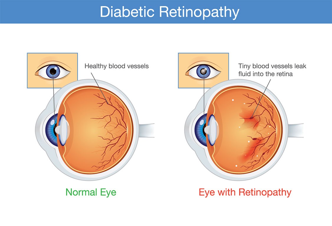 what is diabetic retinopathy