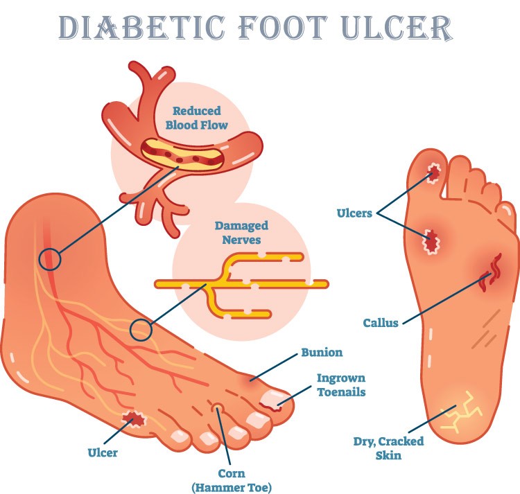 Diabetic Foot Problems – Know What Happens to Your Feet and Legs Due to Diabetes