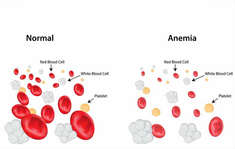 diabetes and anemia