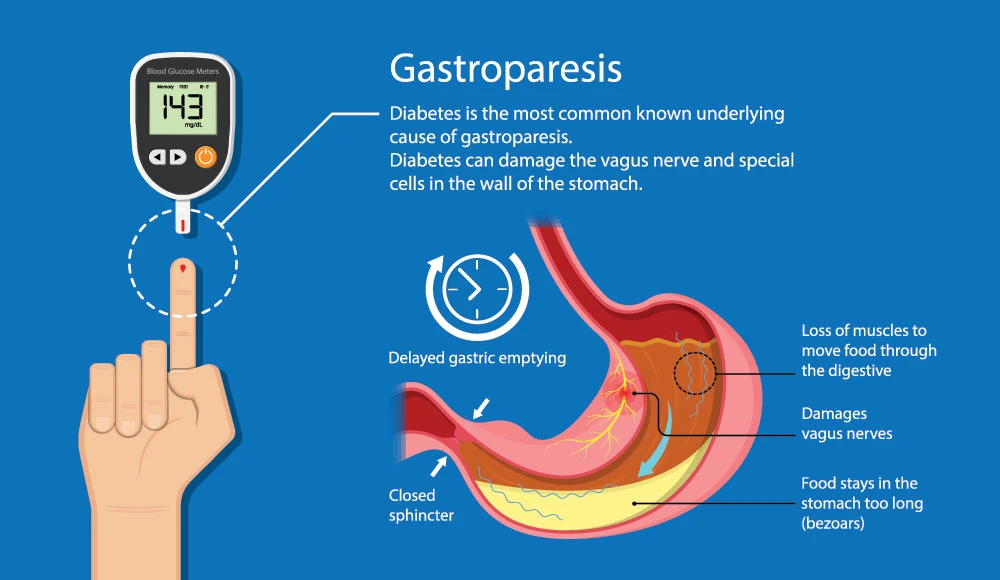 Diabetic Gastroparesis
