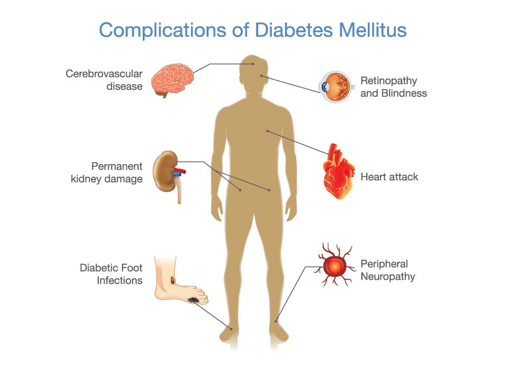 Long Term Complications of Type 2 Diabetes Mellitus